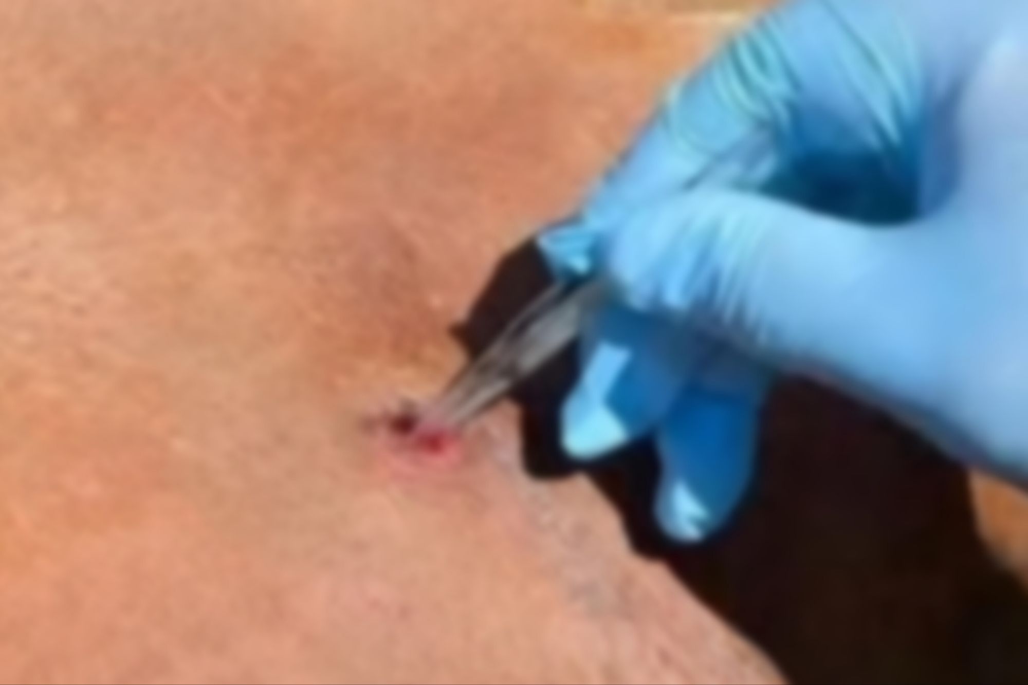 El Argentino Diario-Caso humano de miasis por gusano barrenador.